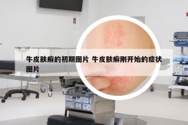 牛皮肤癣的初期图片 牛皮肤癣刚开始的症状图片