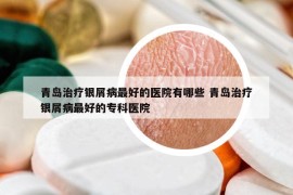 青岛治疗银屑病最好的医院有哪些 青岛治疗银屑病最好的专科医院