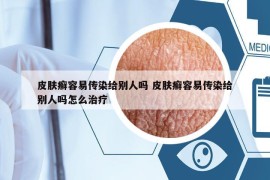 皮肤癣容易传染给别人吗 皮肤癣容易传染给别人吗怎么治疗