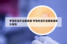 甲泼尼龙片治银屑病 甲泼尼龙片治银屑病多久有效
