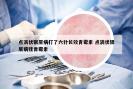 点滴状银屑病打了六针长效青霉素 点滴状银屑病挂青霉素