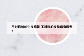 不对称长的牛皮癣是 不对称的皮肤病有哪些?