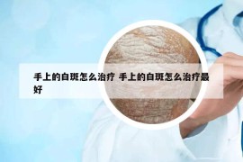 手上的白斑怎么治疗 手上的白斑怎么治疗最好