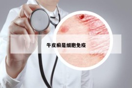 牛皮癣是细胞免疫