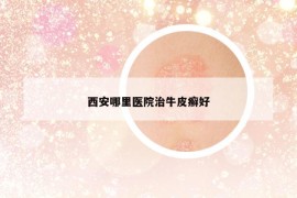 西安哪里医院治牛皮癣好