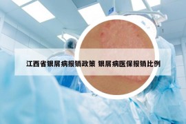 江西省银屑病报销政策 银屑病医保报销比例