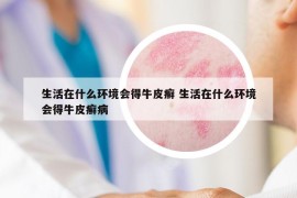 生活在什么环境会得牛皮癣 生活在什么环境会得牛皮癣病