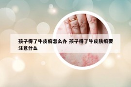 孩子得了牛皮癣怎么办 孩子得了牛皮肤癣要注意什么