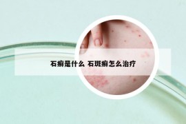石癣是什么 石斑癣怎么治疗