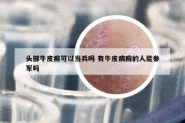 头部牛皮癣可以当兵吗 有牛皮病癣的人能参军吗