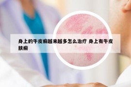 身上的牛皮癣越来越多怎么治疗 身上有牛皮肤癣