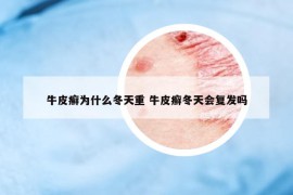 牛皮癣为什么冬天重 牛皮癣冬天会复发吗