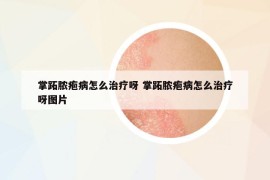 掌跖脓疱病怎么治疗呀 掌跖脓疱病怎么治疗呀图片