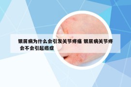 银屑病为什么会引发关节疼痛 银屑病关节疼 会不会引起癌症