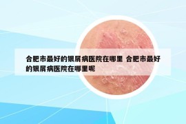 合肥市最好的银屑病医院在哪里 合肥市最好的银屑病医院在哪里呢