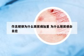 作息规律为什么银屑病加重 为什么银屑病会自愈