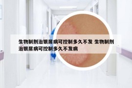 生物制剂治银屑病可控制多久不发 生物制剂治银屑病可控制多久不发病