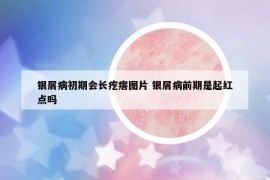 银屑病初期会长疙瘩图片 银屑病前期是起红点吗