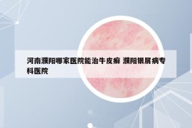 河南濮阳哪家医院能治牛皮癣 濮阳银屑病专科医院