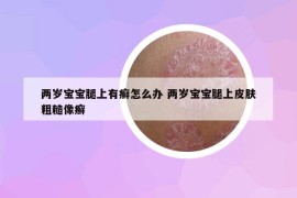两岁宝宝腿上有癣怎么办 两岁宝宝腿上皮肤粗糙像癣
