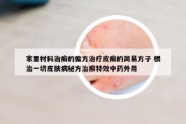 家里材料治癣的偏方治疗皮癣的简易方子 根治一切皮肤病秘方治癣特效中药外用