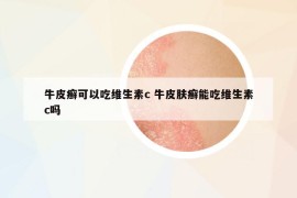 牛皮癣可以吃维生素c 牛皮肤癣能吃维生素c吗