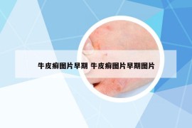牛皮癣图片早期 牛皮癣图片早期图片