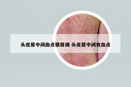 头皮屑中间血点银屑病 头皮屑中间有血点
