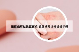 银屑病可以戴耳环吗 银屑病可以带银镯子吗