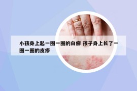 小孩身上起一圈一圈的白癣 孩子身上长了一圈一圈的皮疹
