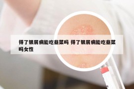 得了银屑病能吃韭菜吗 得了银屑病能吃韭菜吗女性
