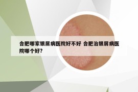 合肥哪家银屑病医院好不好 合肥治银屑病医院哪个好?