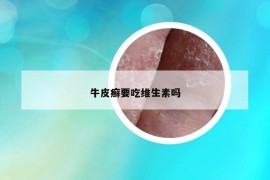 牛皮癣要吃维生素吗