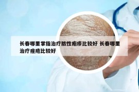 长春哪里掌指治疗脓性疱疹比较好 长春哪里治疗痤疮比较好