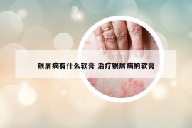 银屑病有什么软膏 治疗银屑病的软膏