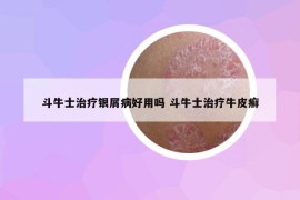 斗牛士治疗银屑病好用吗 斗牛士治疗牛皮癣