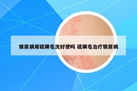 银屑病用硫磺皂洗好使吗 硫磺皂治疗银屑病