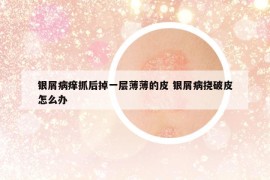 银屑病痒抓后掉一层薄薄的皮 银屑病挠破皮怎么办