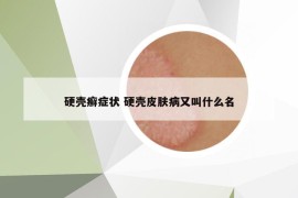 硬壳癣症状 硬壳皮肤病又叫什么名