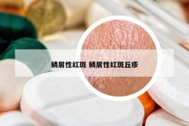 鳞屑性红斑 鳞屑性红斑丘疹