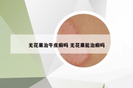 无花果治牛皮癣吗 无花果能治癣吗