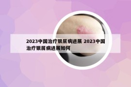 2023中国治疗银屑病进展 2023中国治疗银屑病进展如何