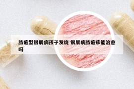脓疱型银屑病孩子发烧 银屑病脓疱疹能治愈吗