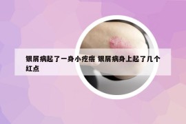 银屑病起了一身小疙瘩 银屑病身上起了几个红点
