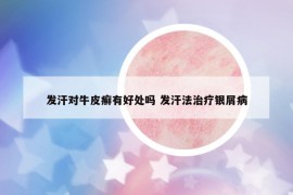 发汗对牛皮癣有好处吗 发汗法治疗银屑病