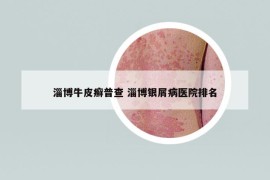 淄博牛皮癣普查 淄博银屑病医院排名