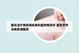 重庆治疗银屑病皮肤科医院哪家好 重庆市专治银屑病医院