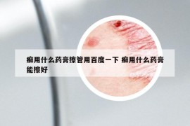 癣用什么药膏擦管用百度一下 癣用什么药膏能擦好