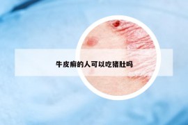 牛皮癣的人可以吃猪肚吗