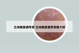 兰州银屑病专家 兰州银屑病专家哪个好